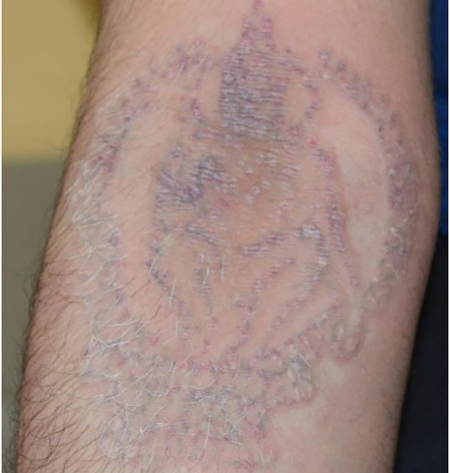 Laser Tattoo Removal At MIRA Clinic West Perth. - MIRA Clinic
